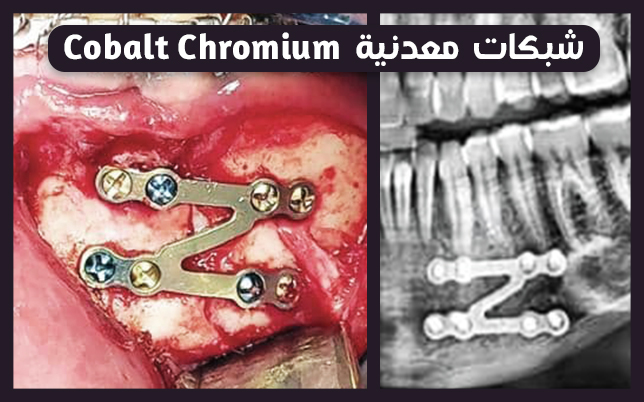 خدمة شبكات كوبالت-كروم في معمل الجُماعي
