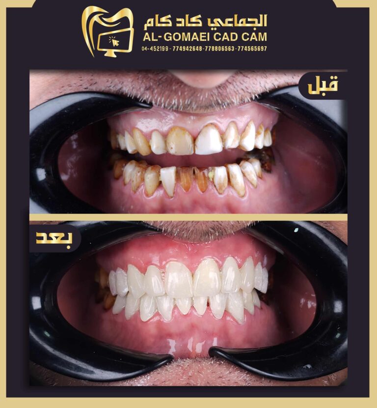 بعد العلاج — تنفيذ متكامل — زركونيا وفينير